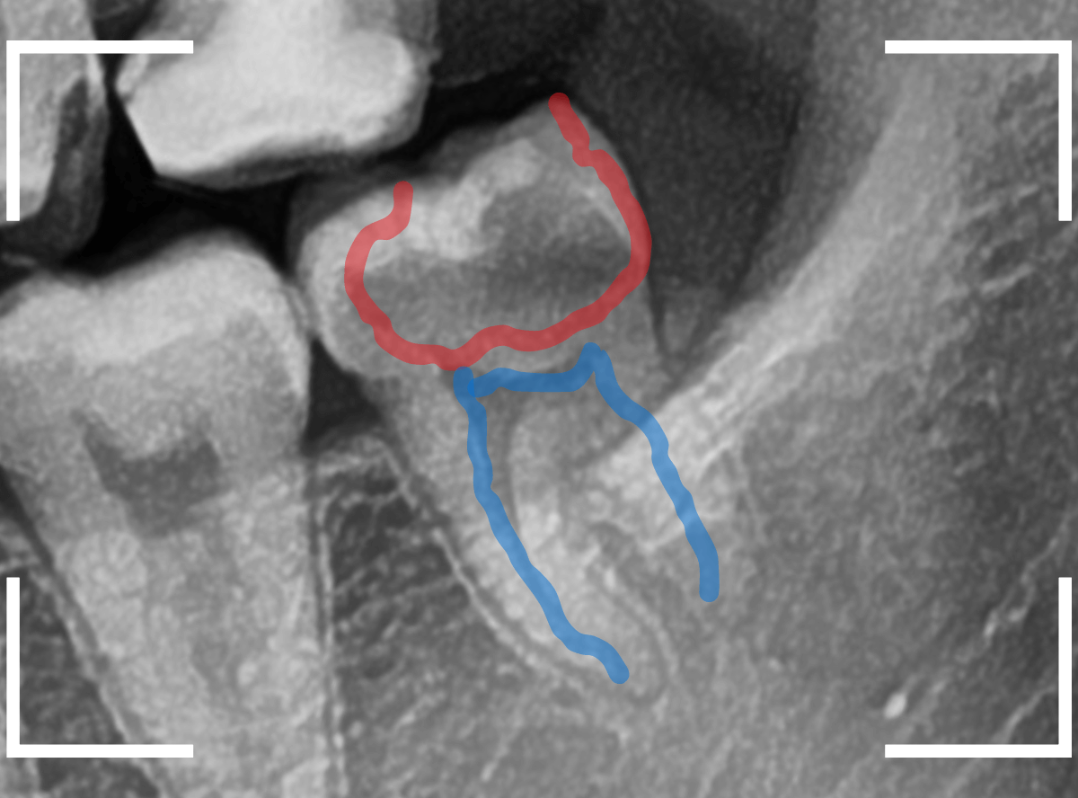 おやしらずの抜歯18-2