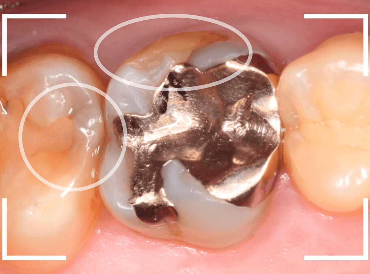 つめものの下の深い虫歯(画像)10-1