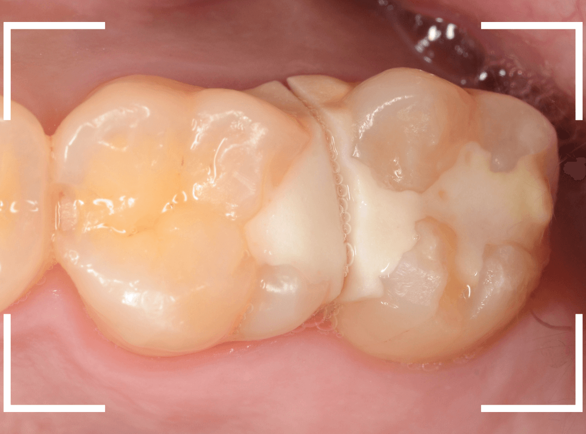 セラミック治療(インレー)31-1
