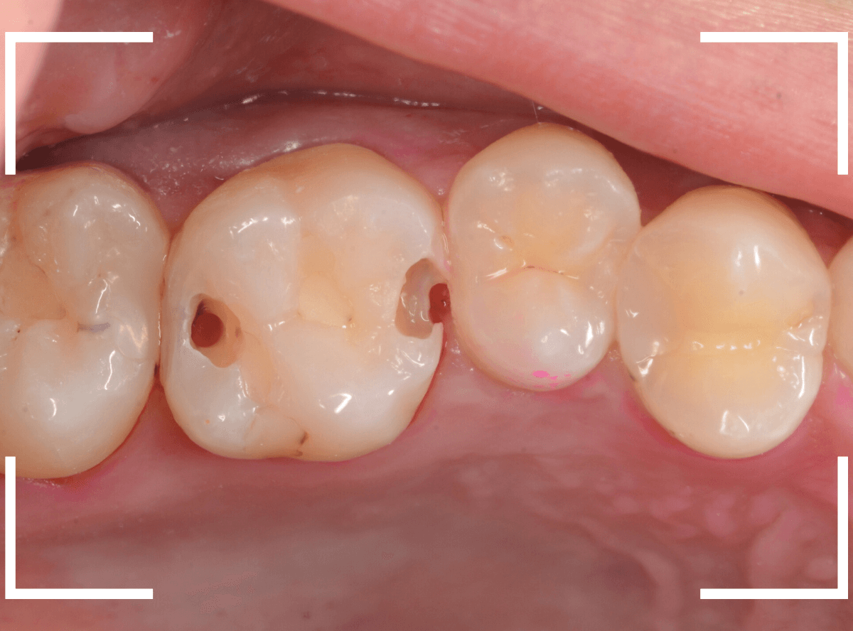 歯と歯の間の虫歯17-3
