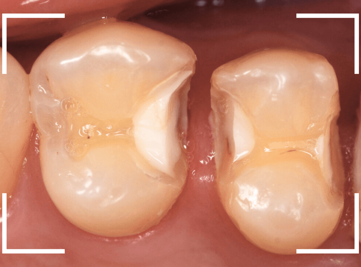 セラミック治療(インレー)21-2