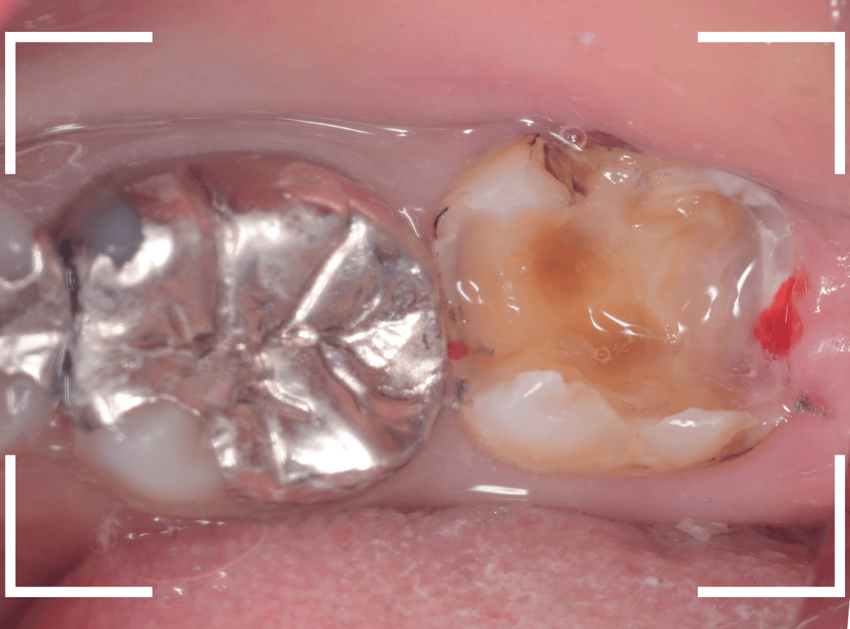 つめものの下の深い虫歯(画像)10-1