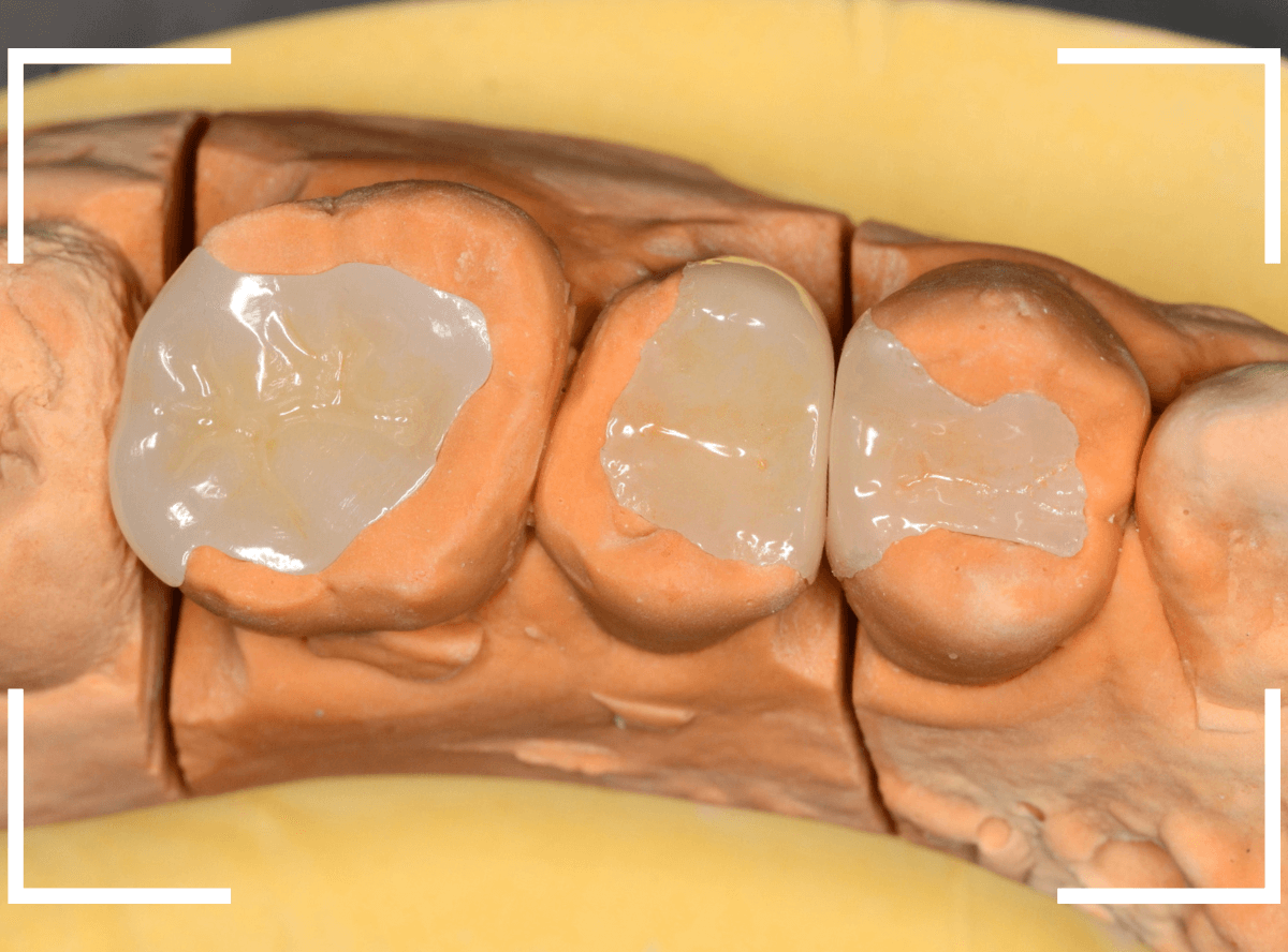 セラミック治療(インレー)32-11