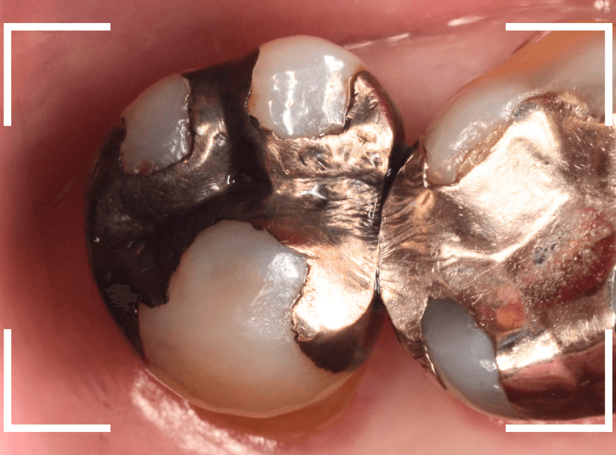 つめものの下の深い虫歯(画像)10-1