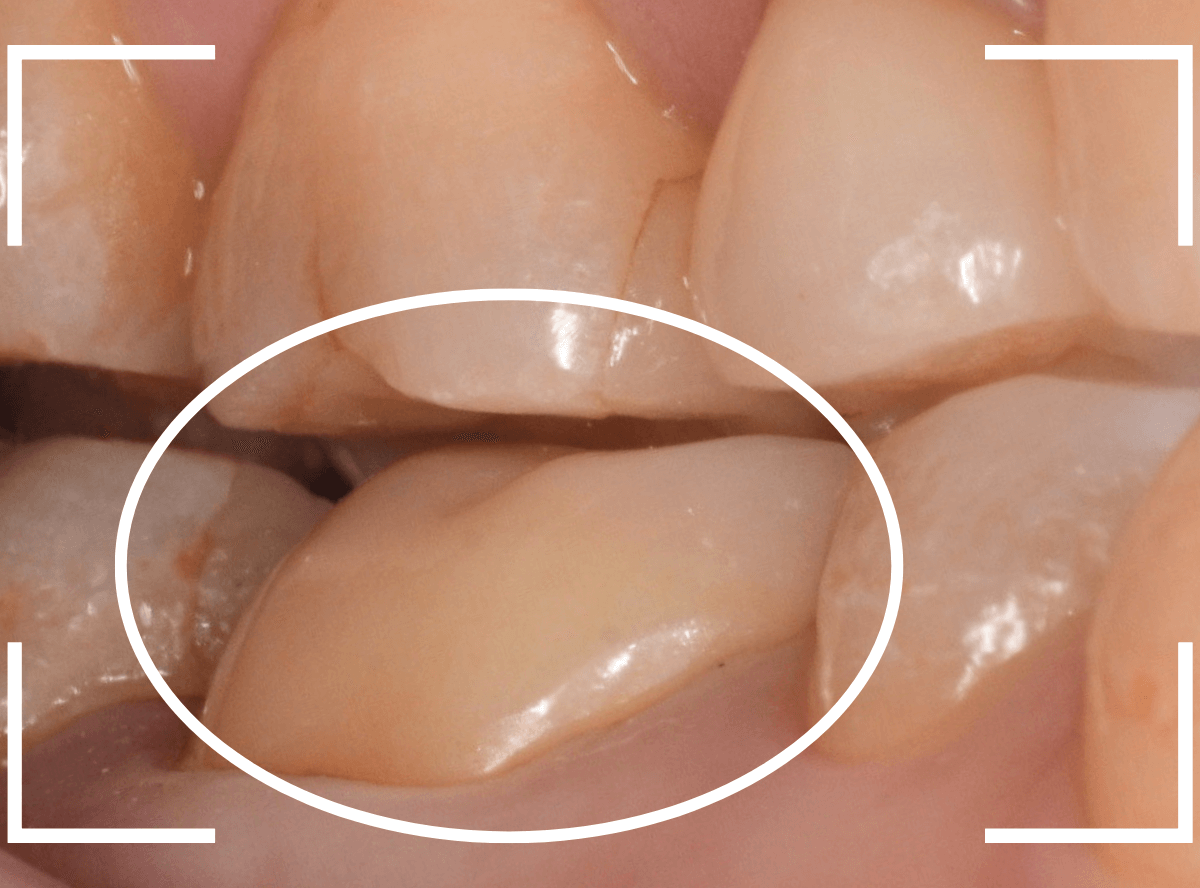 セラミック治療(クラウン・奥歯)7-7