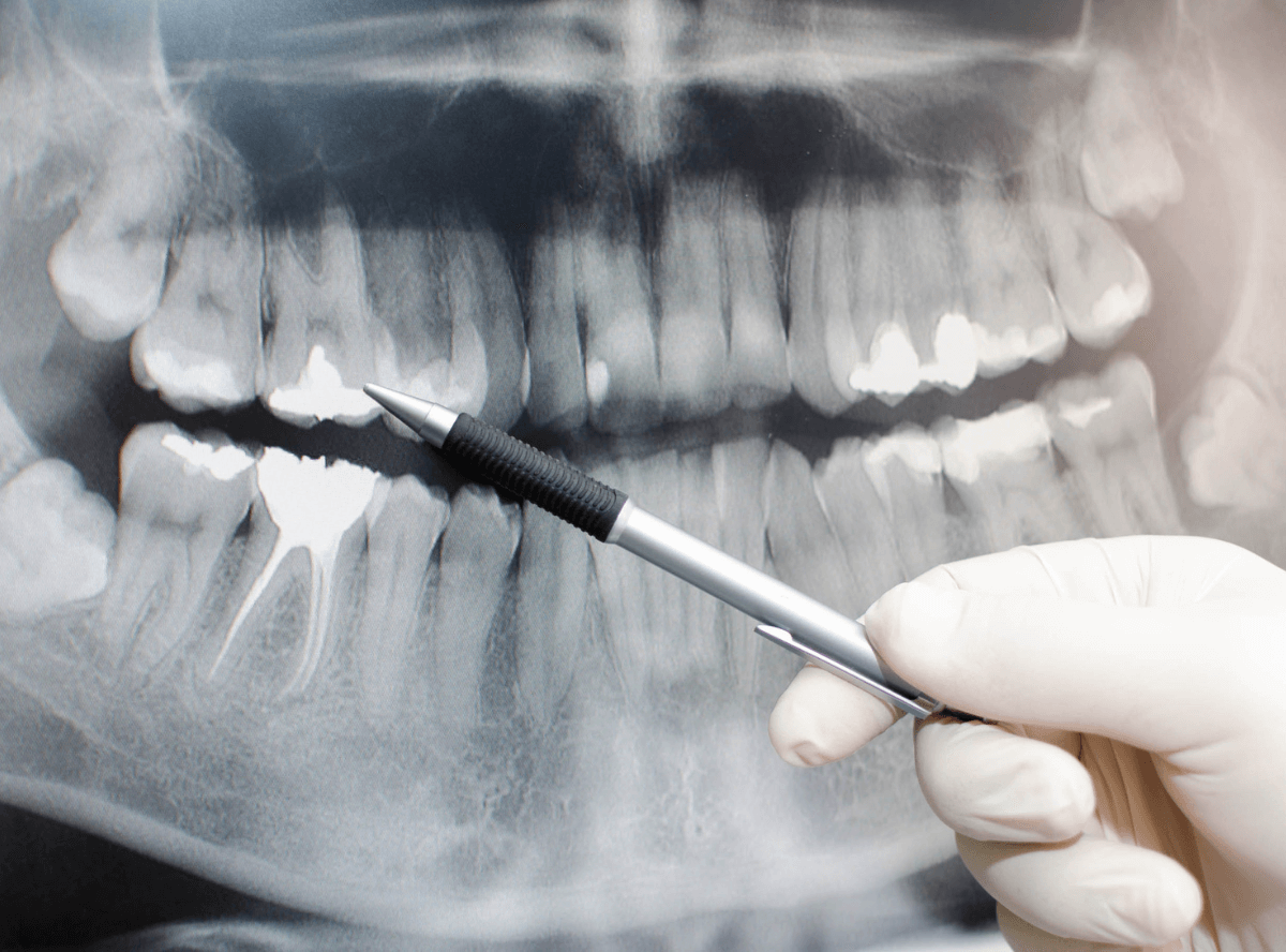 診断がつきづらい虫歯