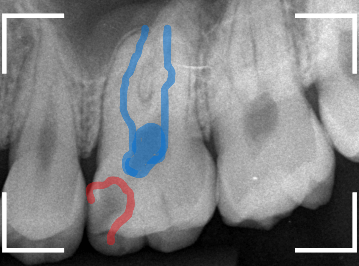 気づかないうちに深い虫歯4-2