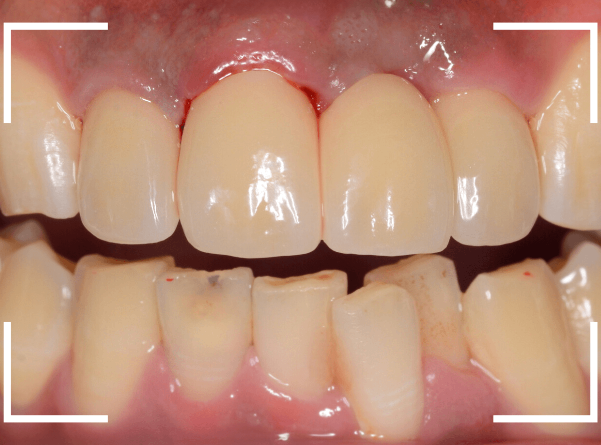 セラミック治療(前歯・クラウン)4-10