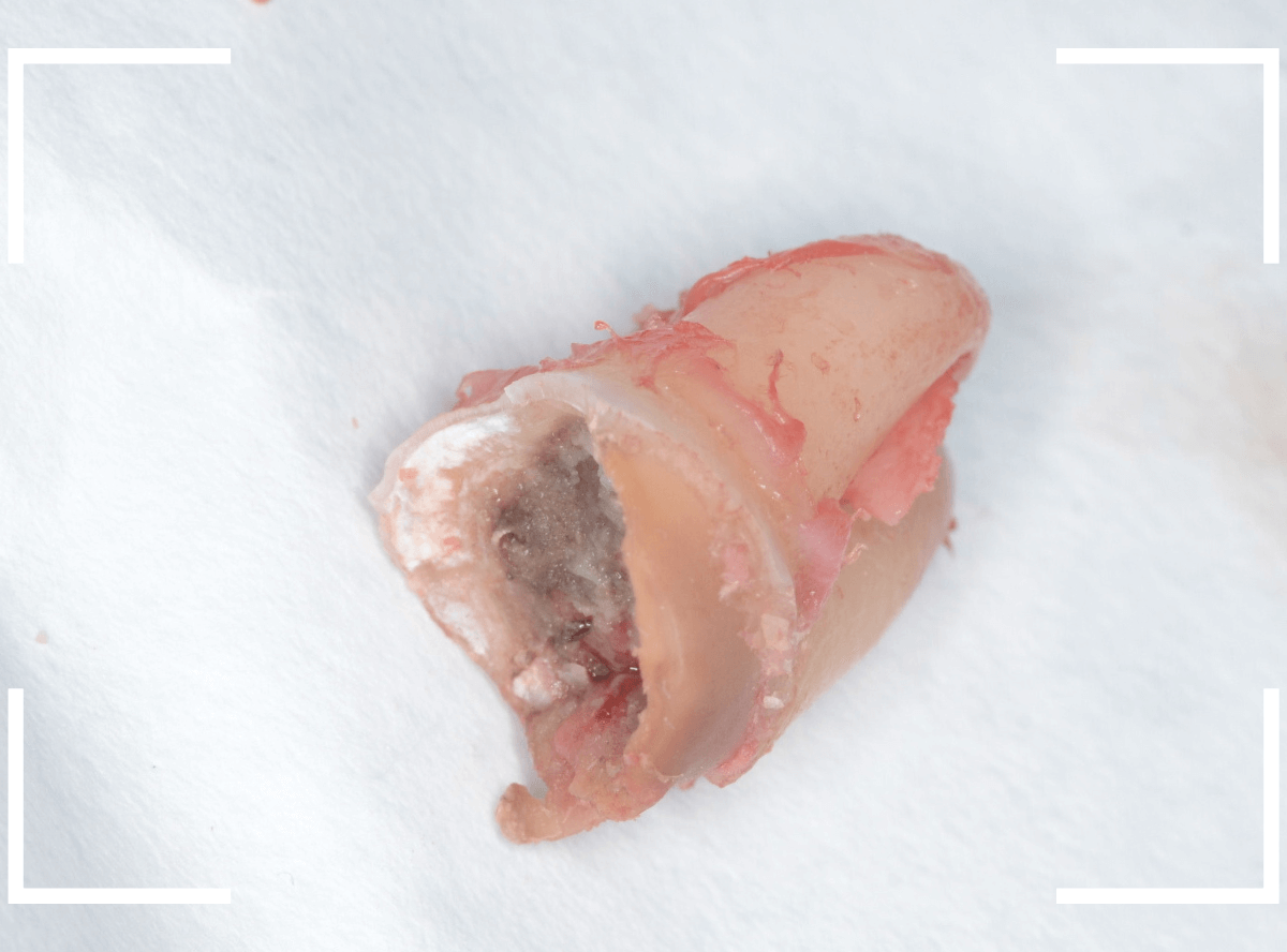 おやしらずの抜歯8-3