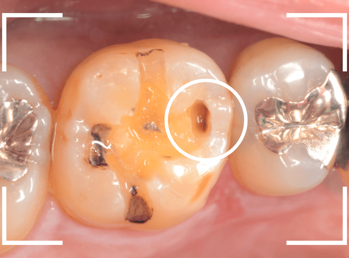 歯と歯の間の虫歯25-4