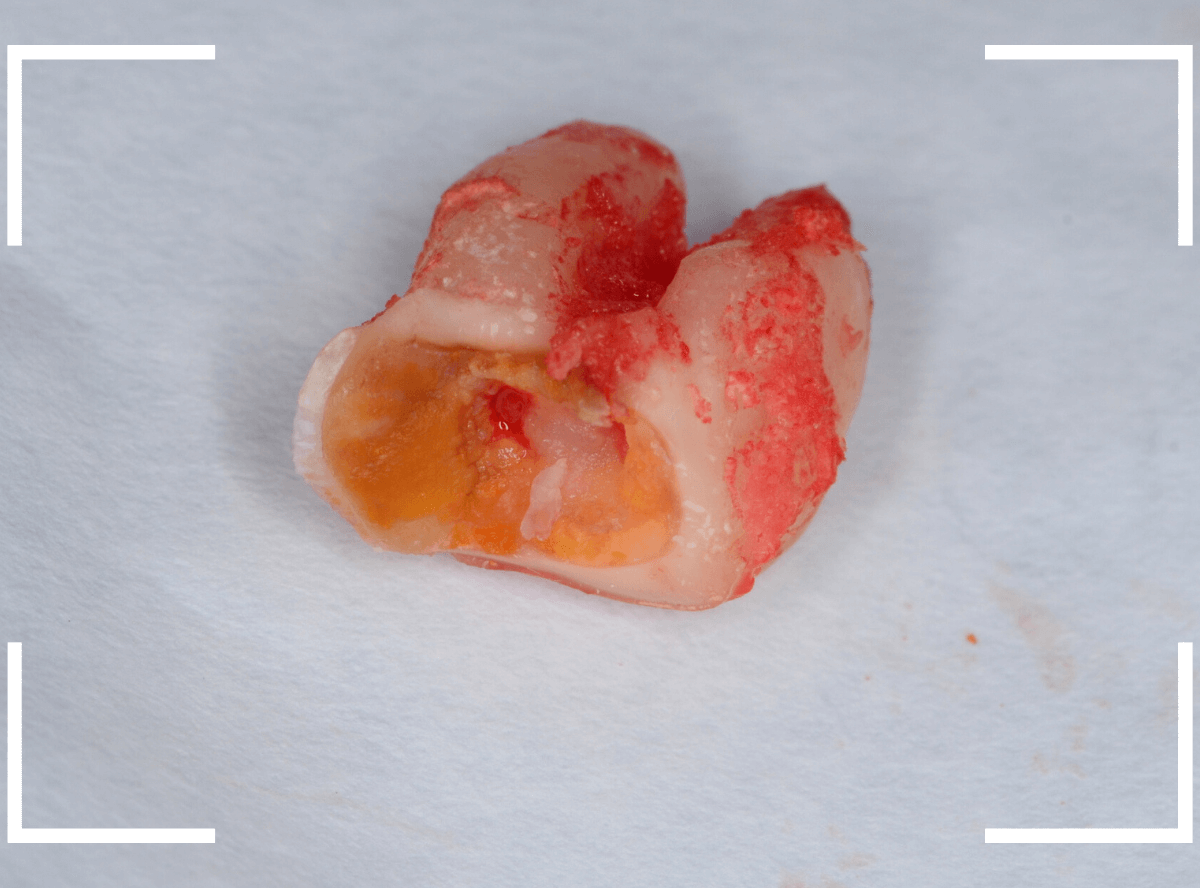 おやしらずの抜歯12-3