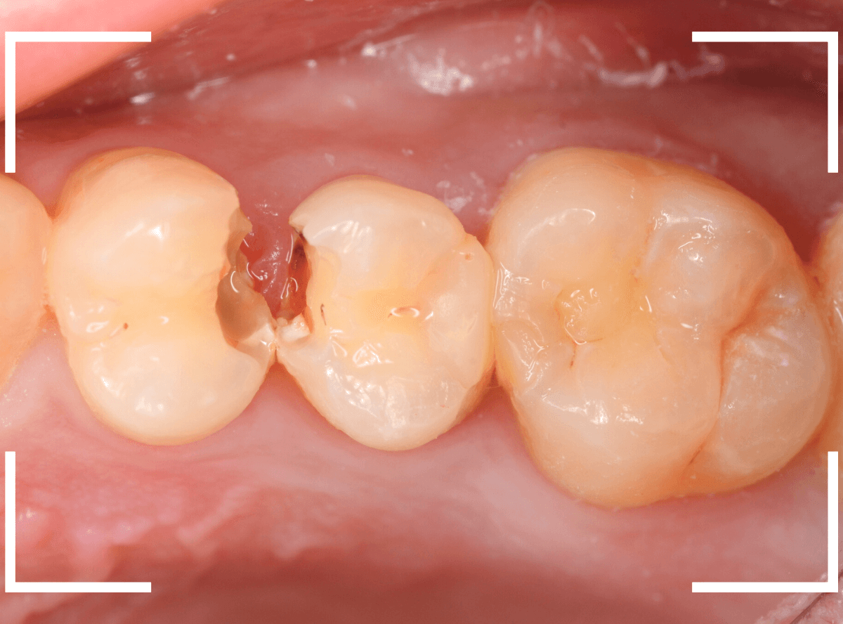つめものの下の深い深い虫歯17-3