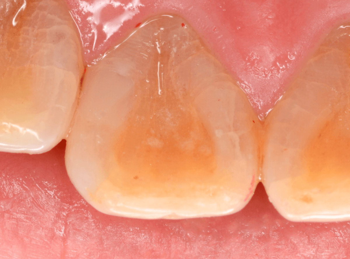 コンポジットレジン治療5-4