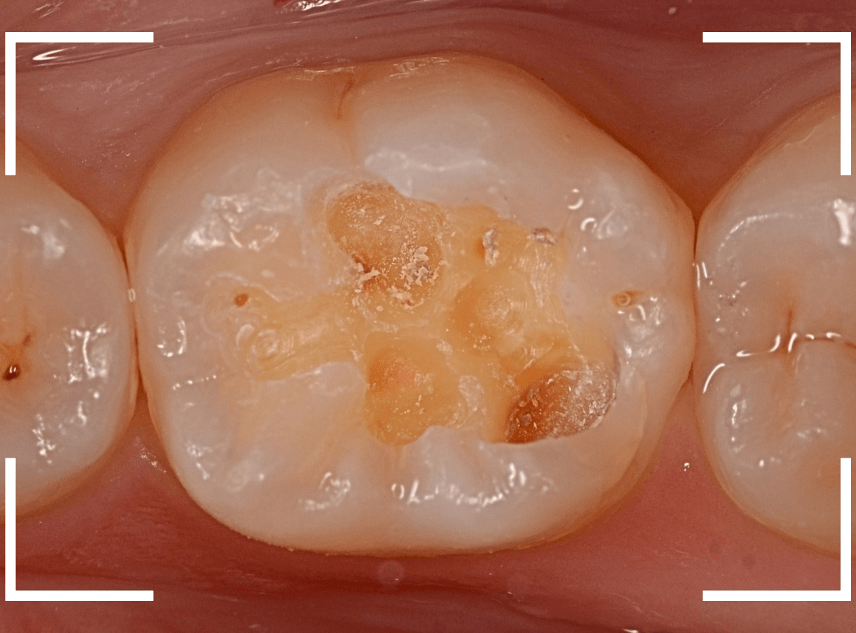 レントゲンでわかりづらい虫歯16-4