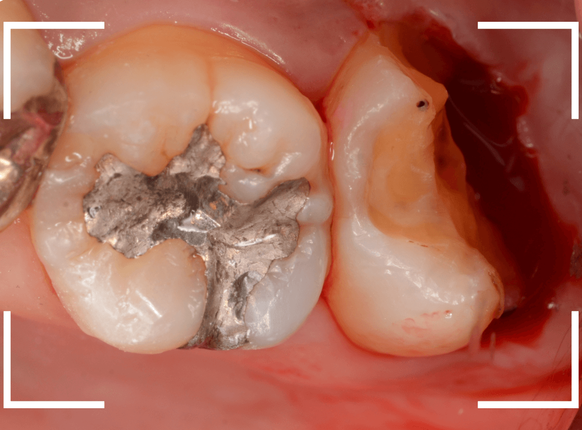 つめものの下の深い虫歯(画像)10-1