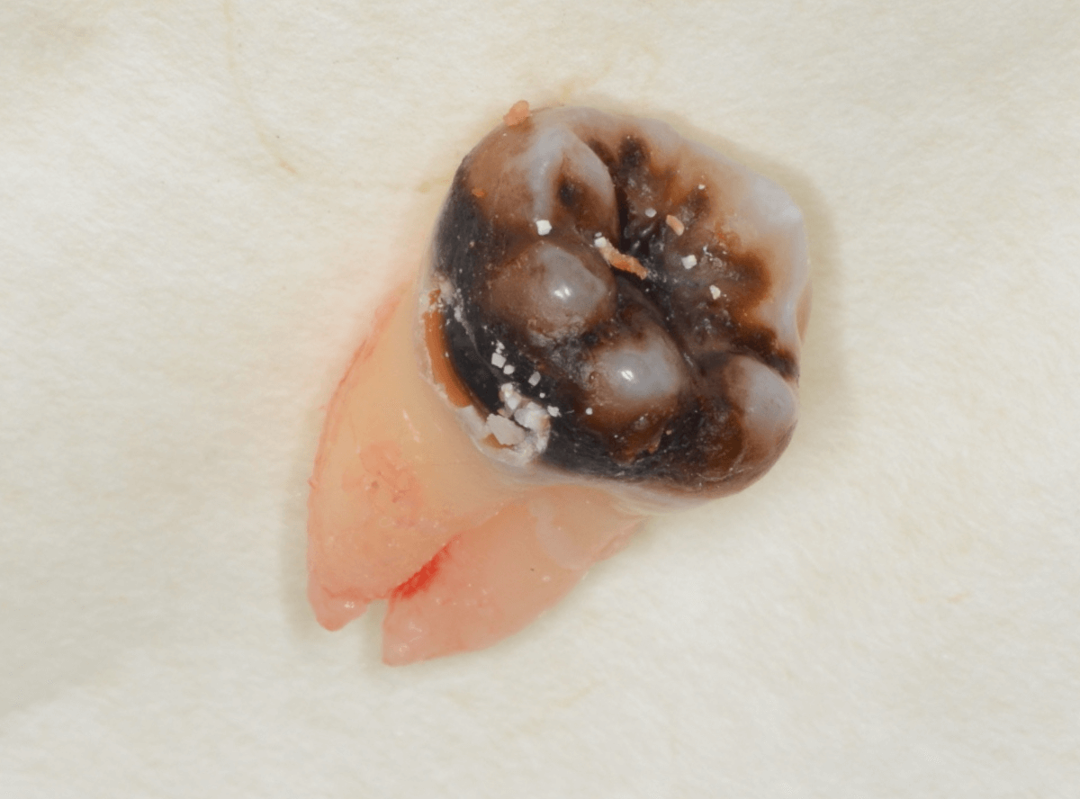 おやしらずの抜歯1-4