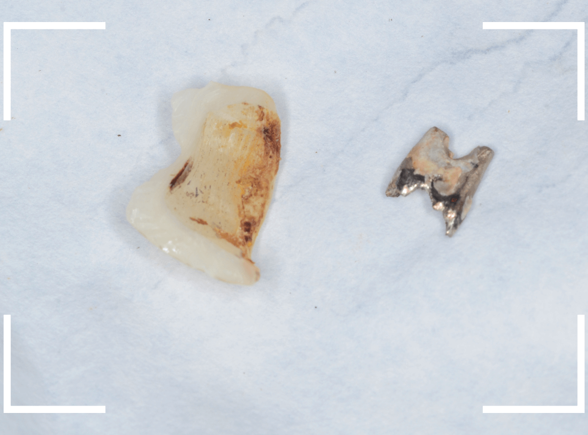 セラミック治療(クラウン・奥歯)9-3