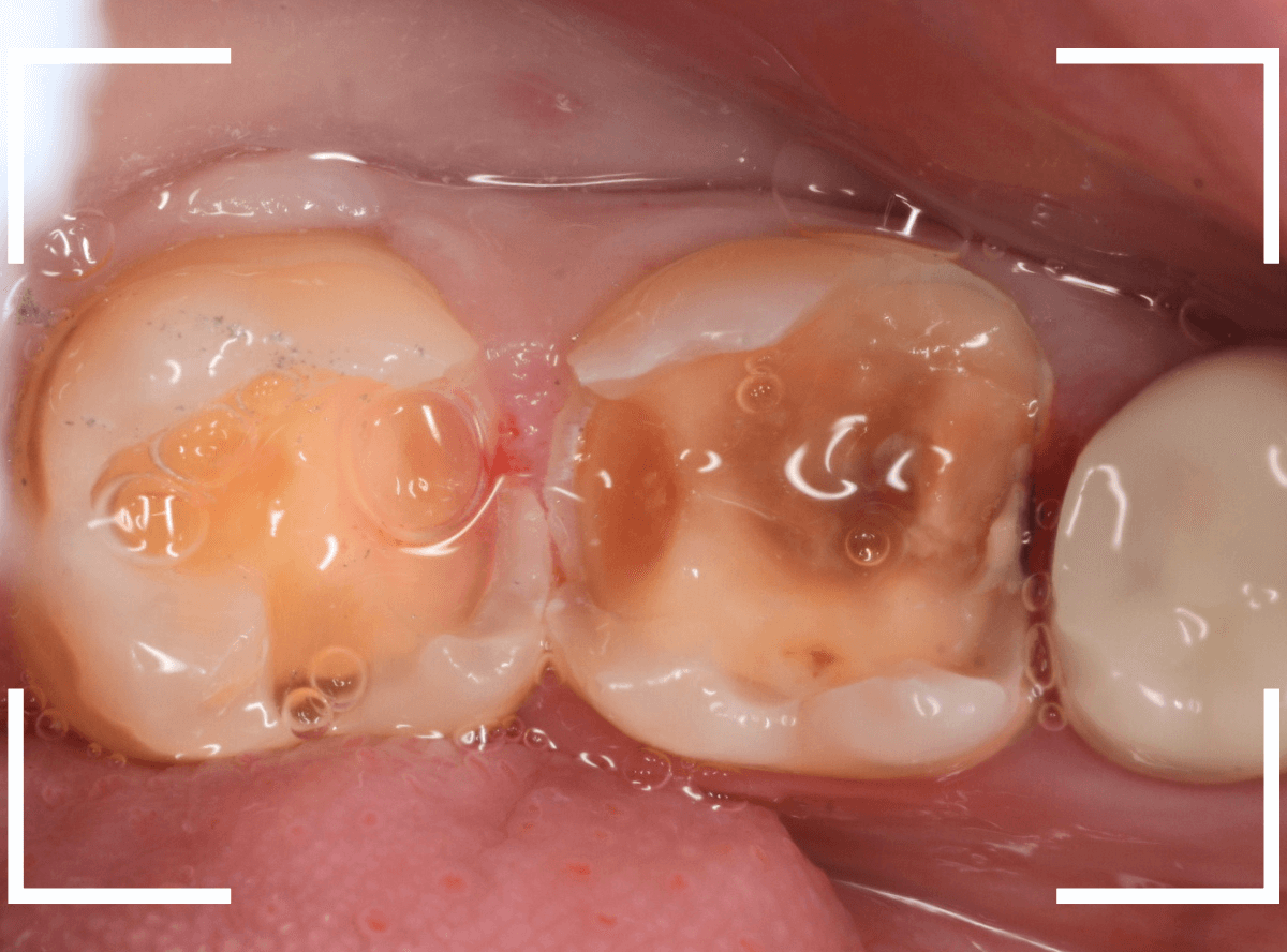歯と歯の間の虫歯18-6