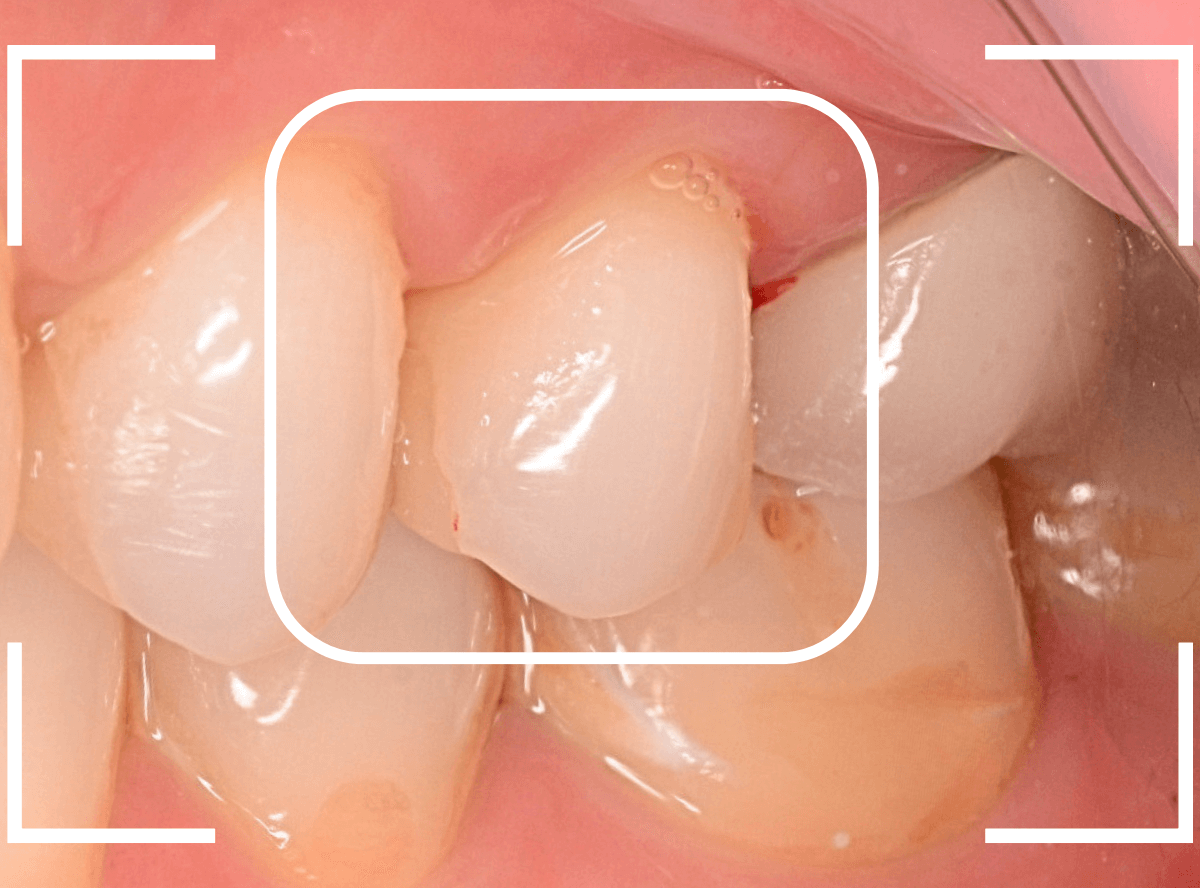 セラミック治療(インレー)22-5