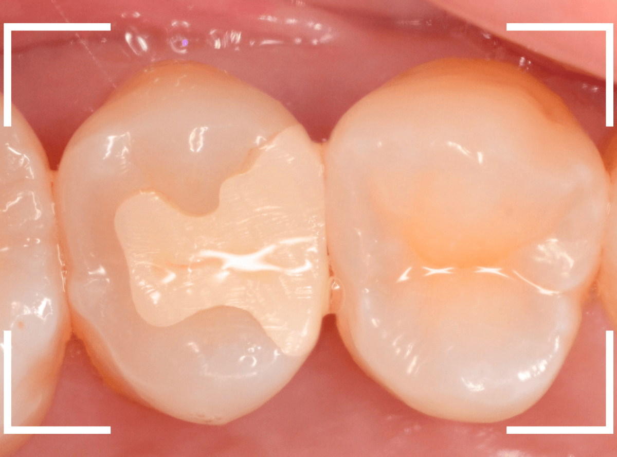 セラミック治療(インレー)27-1