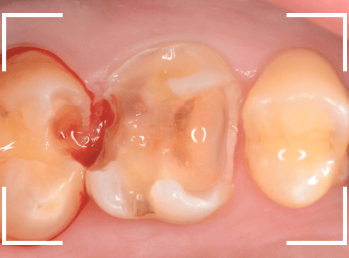 つめものの下の深い虫歯(画像)10-1