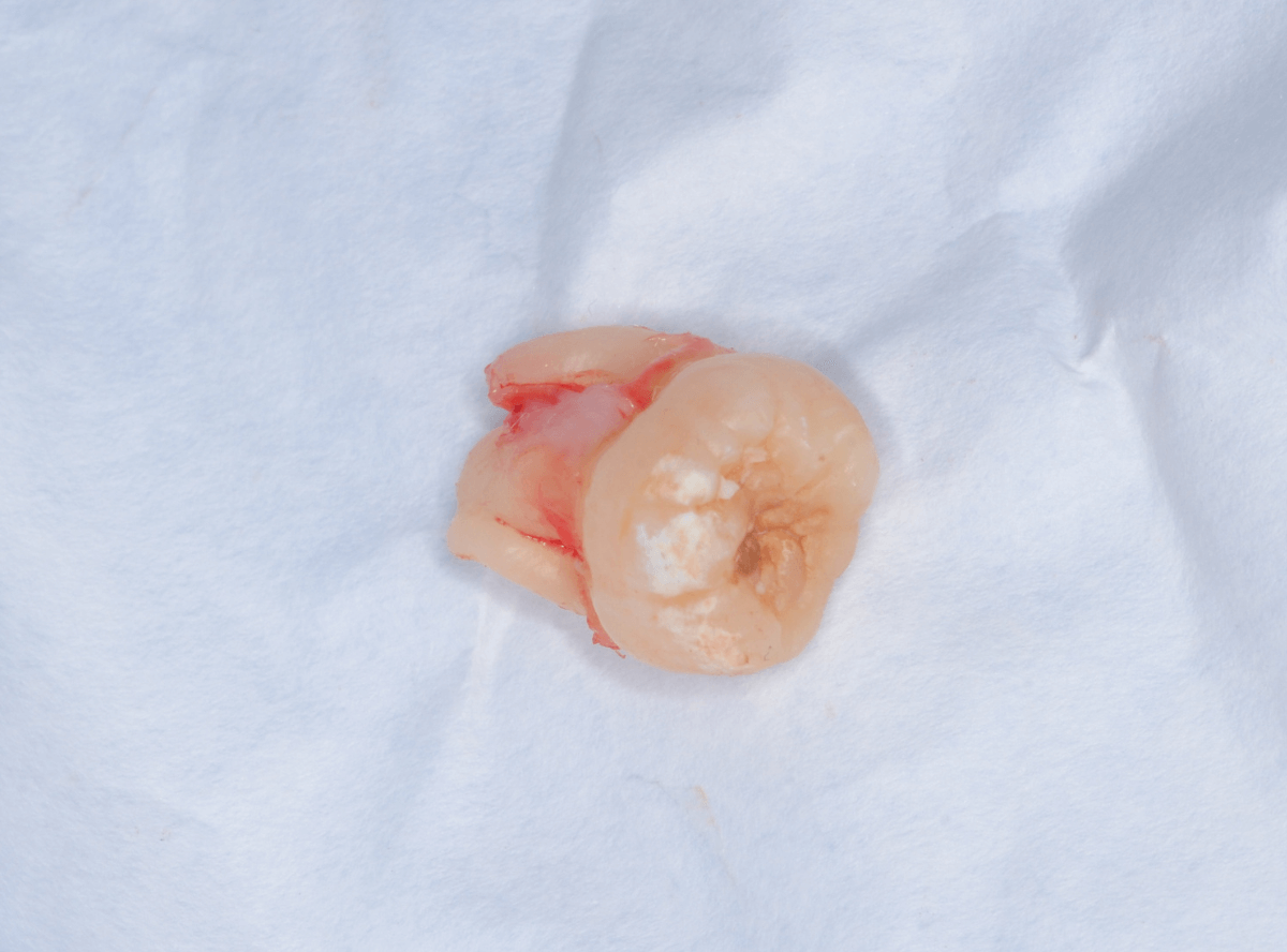 おやしらずの抜歯3-3