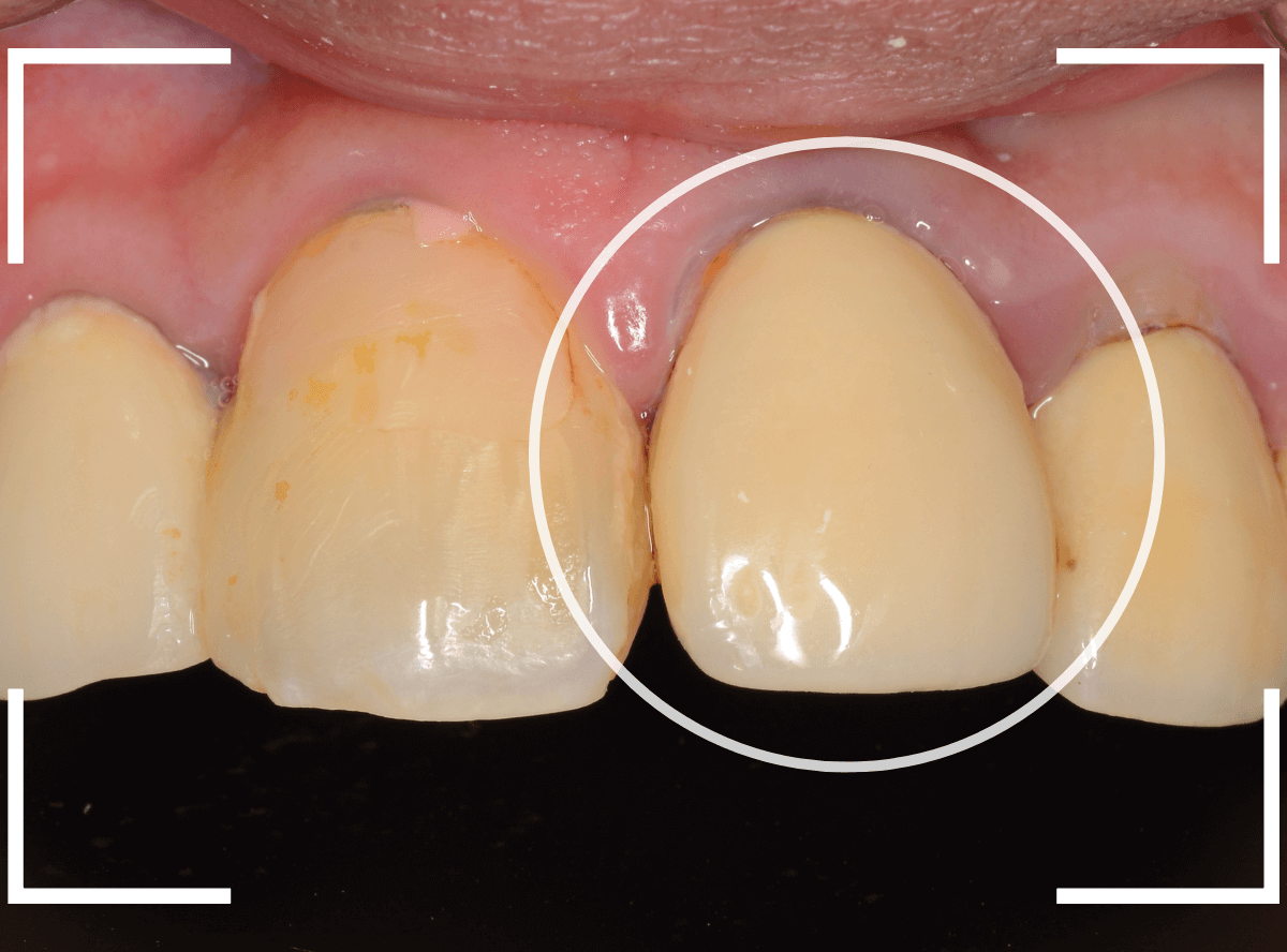 歯肉の中の歯石（歯肉縁下歯石）除去(画像）5-1