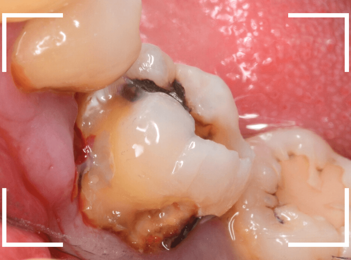 つめものの下の深い深い虫歯12-3