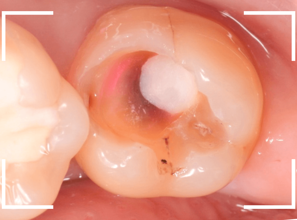 つめものの下の深い虫歯(画像)10-1