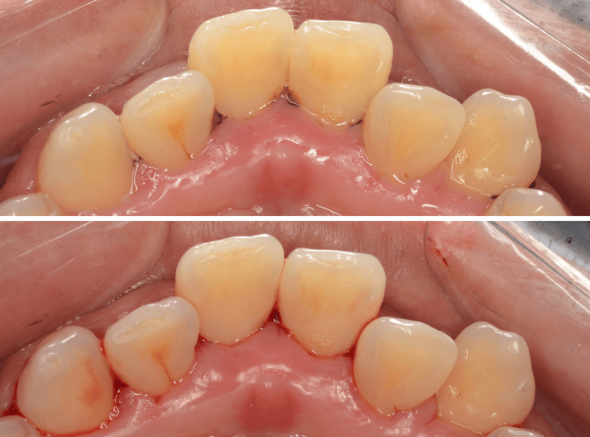 歯肉の中の歯石（歯肉縁下歯石）除去(画像）4-5