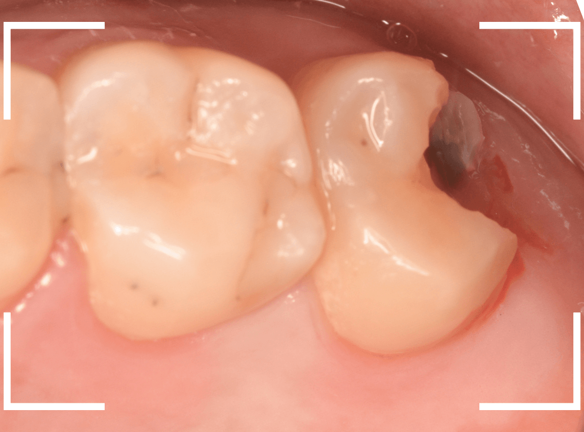 気づかないうちに深い虫歯5-3