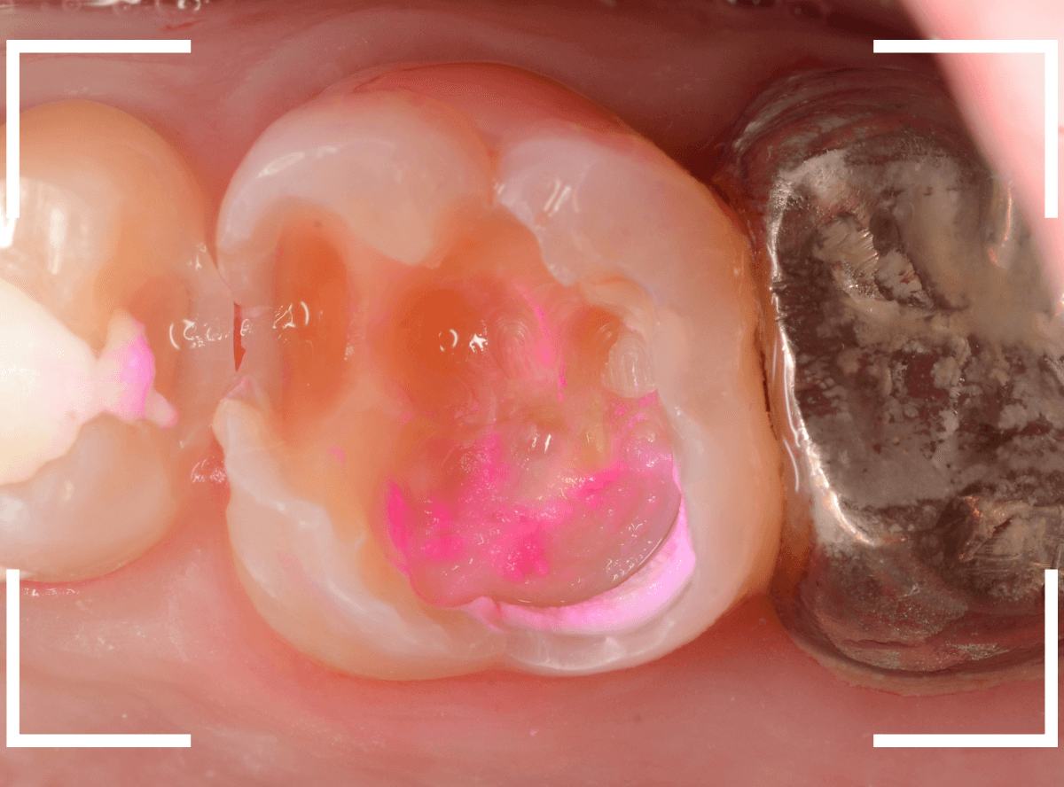 つめものの下の深い深い虫歯20-1