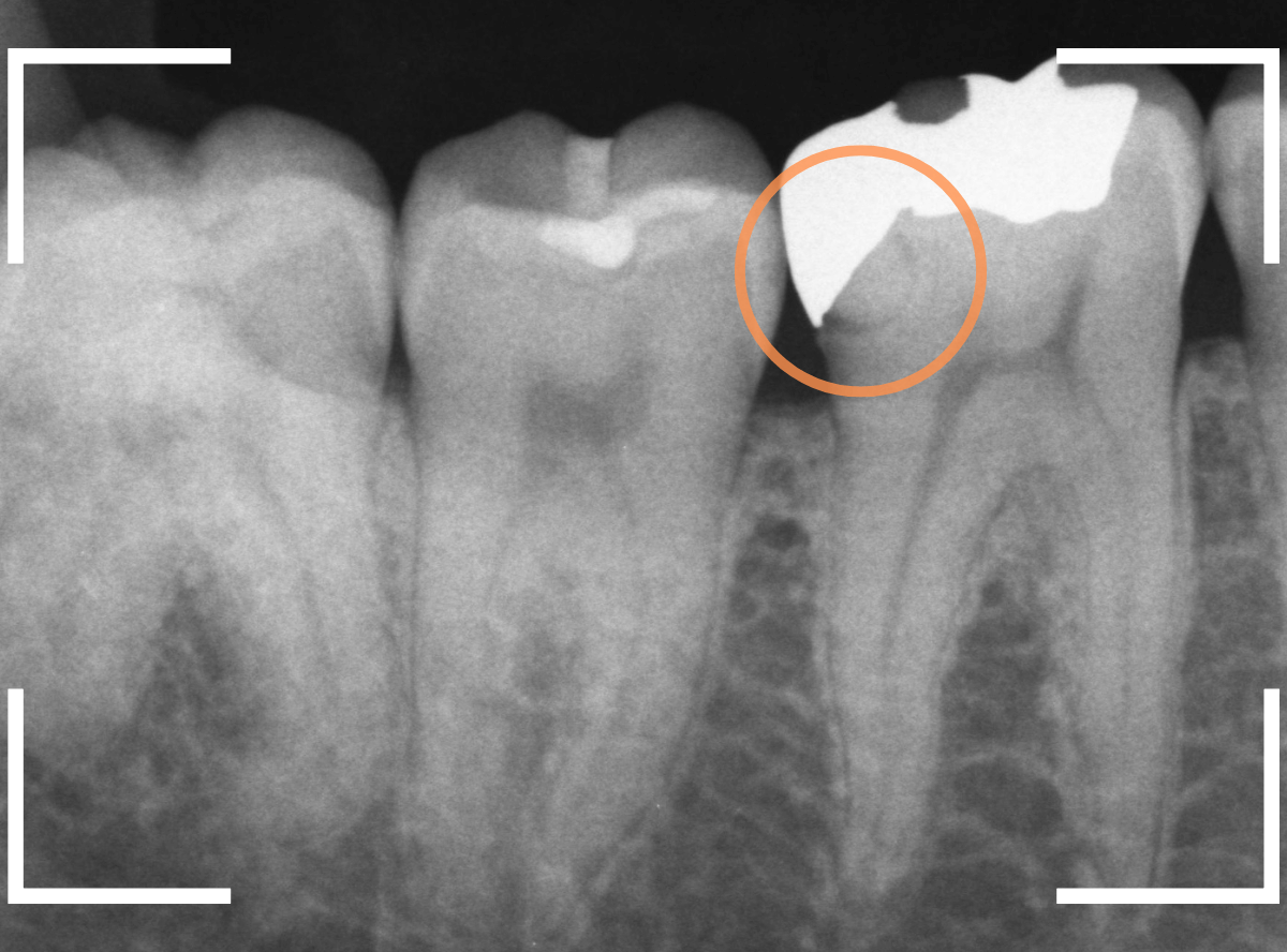 つめものの下の深い虫歯(画像)10-1