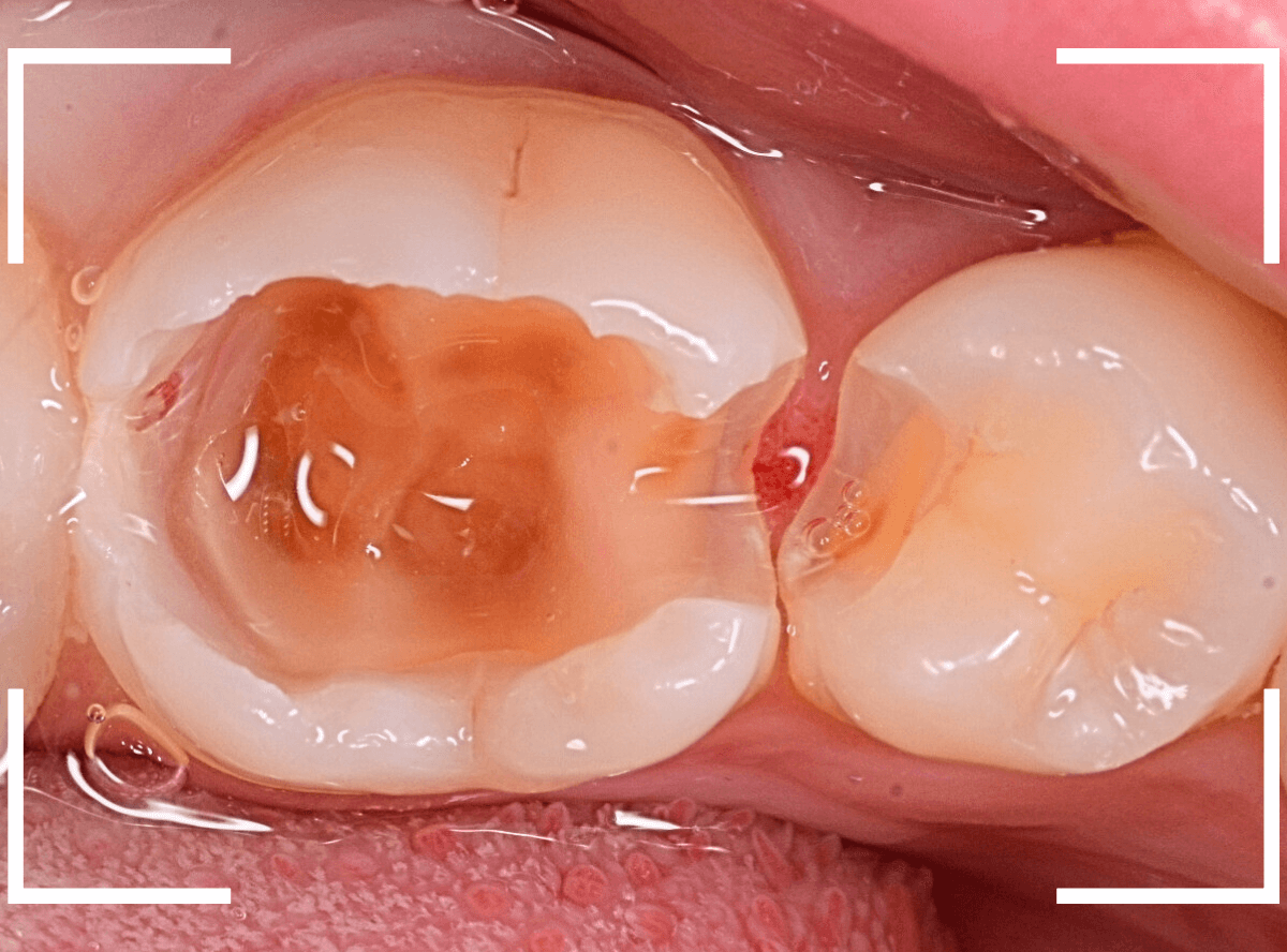 小窩裂溝う蝕1-7