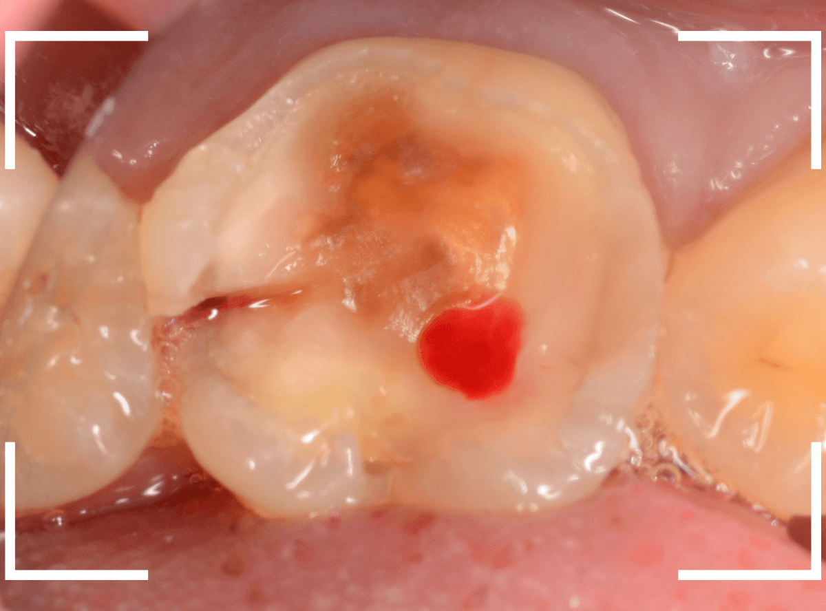 レントゲンでわかりづらい虫歯21-5