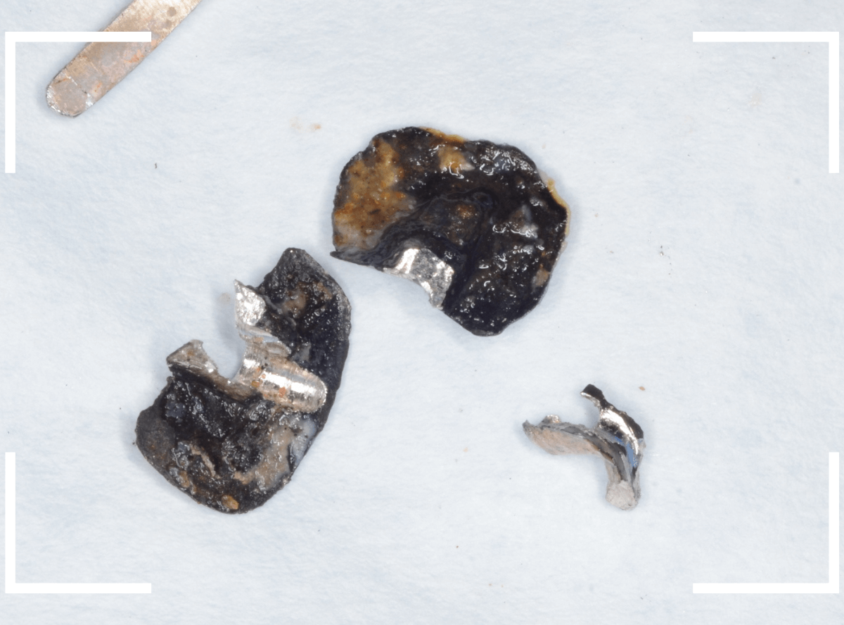 つめものの下の深い虫歯(画像)10-1