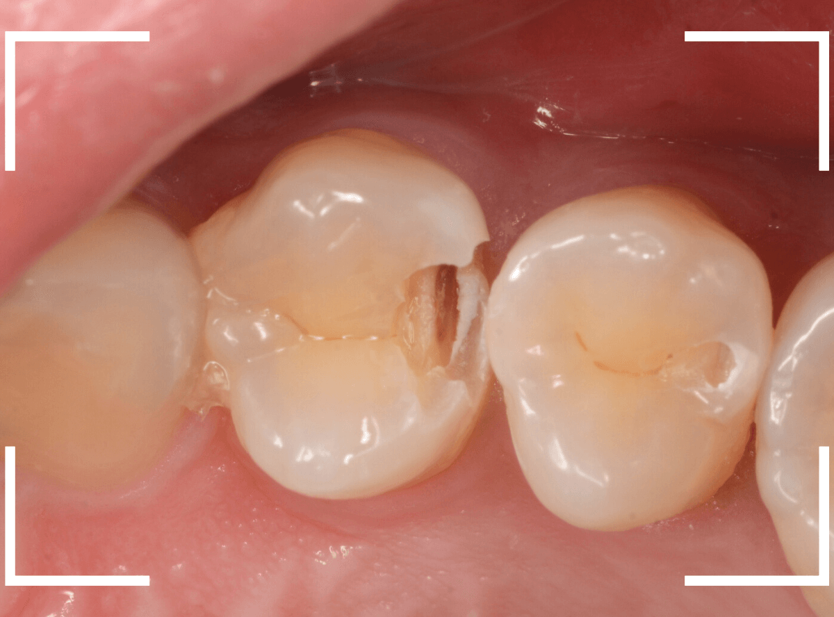 歯と歯の間の虫歯16-4