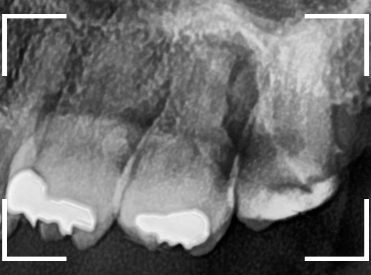 気づかないうちに深い虫歯18-2