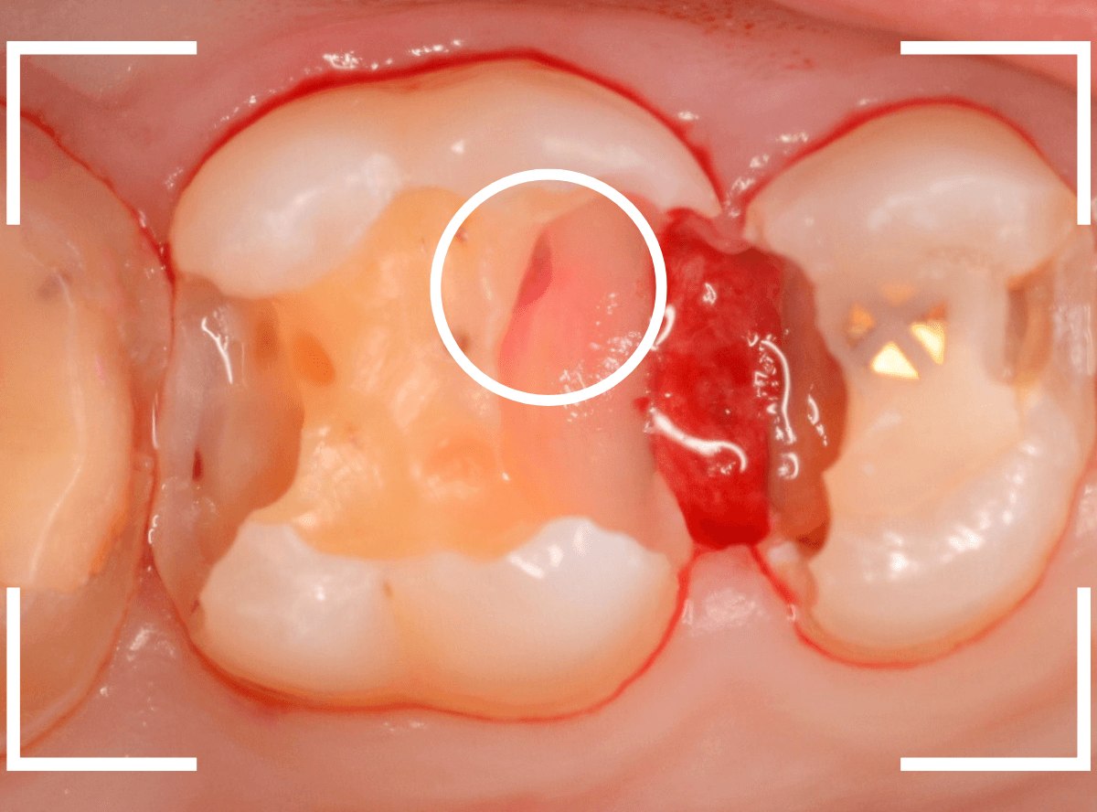 気づかないうちに深い虫歯7-5
