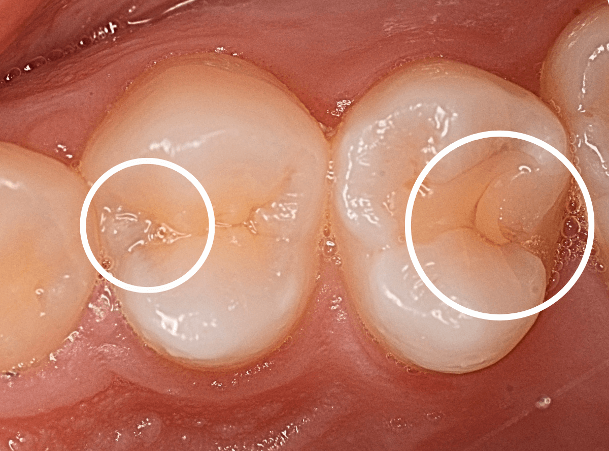 つめものの下の深い深い虫歯11-1