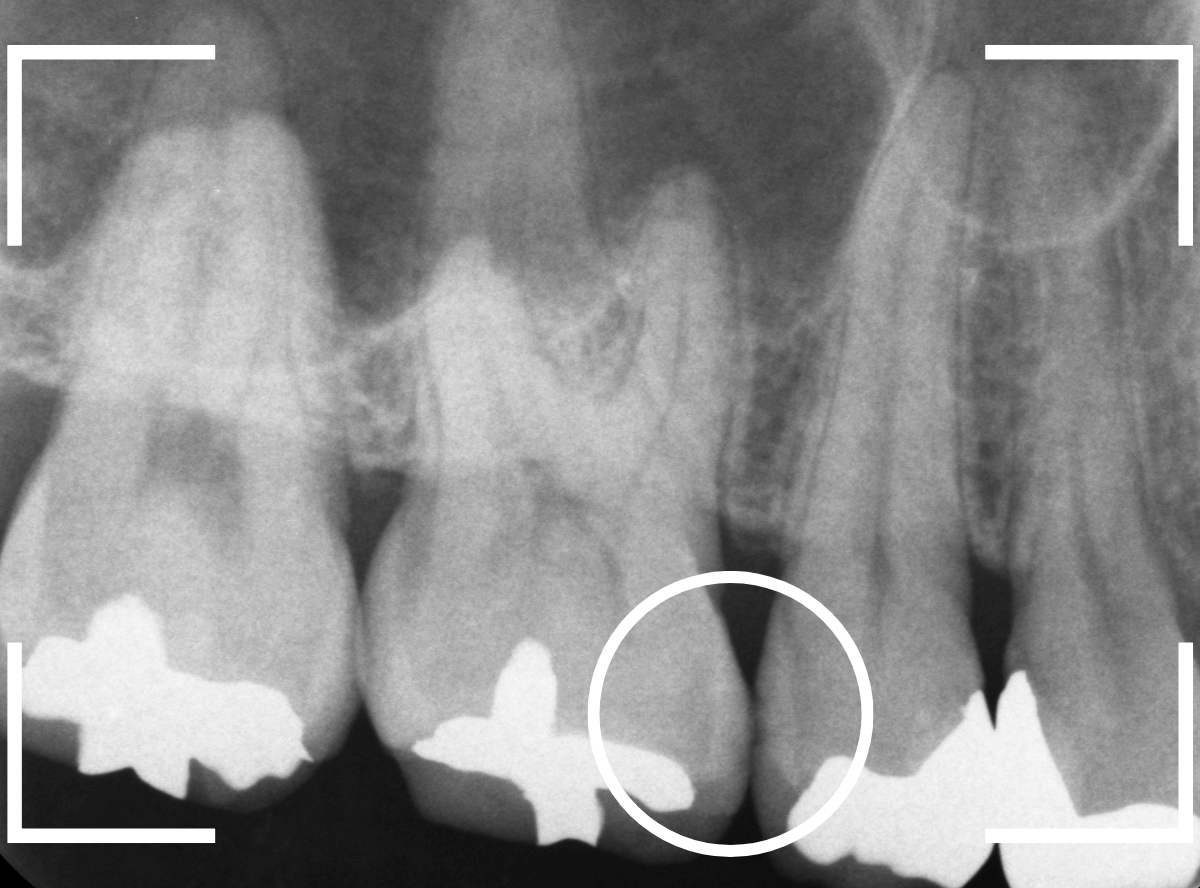 歯と歯の間の虫歯25-2