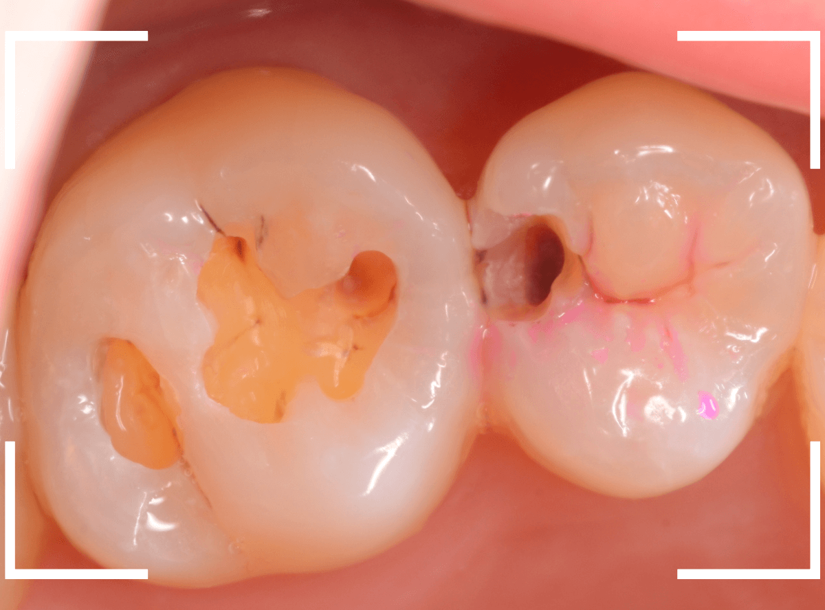 レントゲンでわかりづらい虫歯9-4