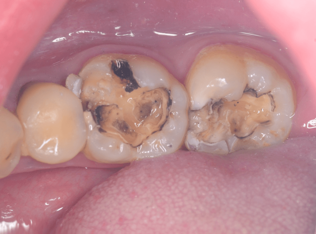 つめものの下の深い虫歯(画像)1-3