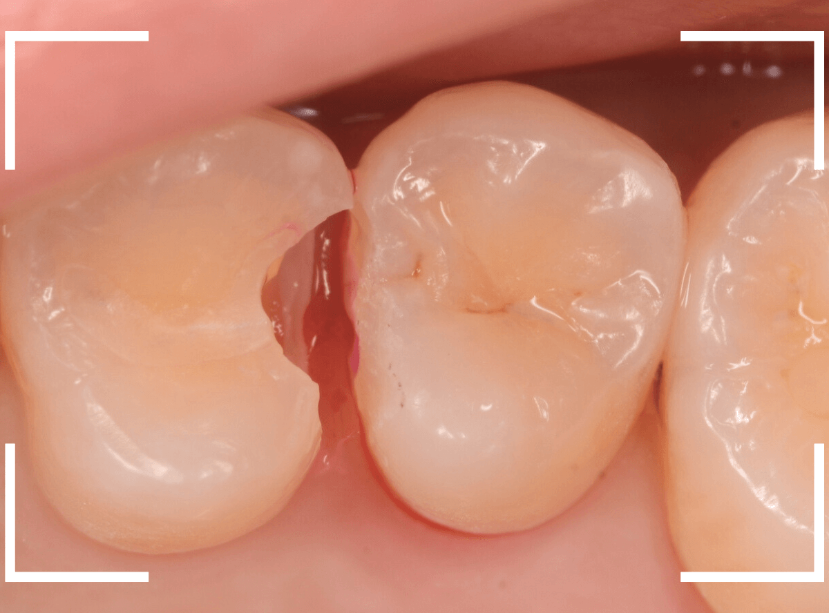 レントゲンでわかりづらい虫歯7-4