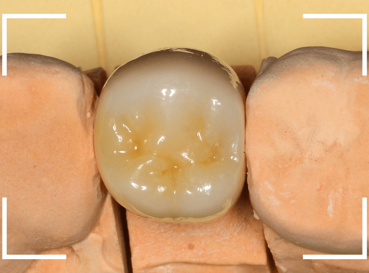セラミック治療(クラウン・奥歯)8-4