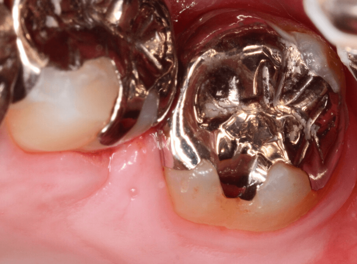 つめものの下の深い虫歯(画像)4-8