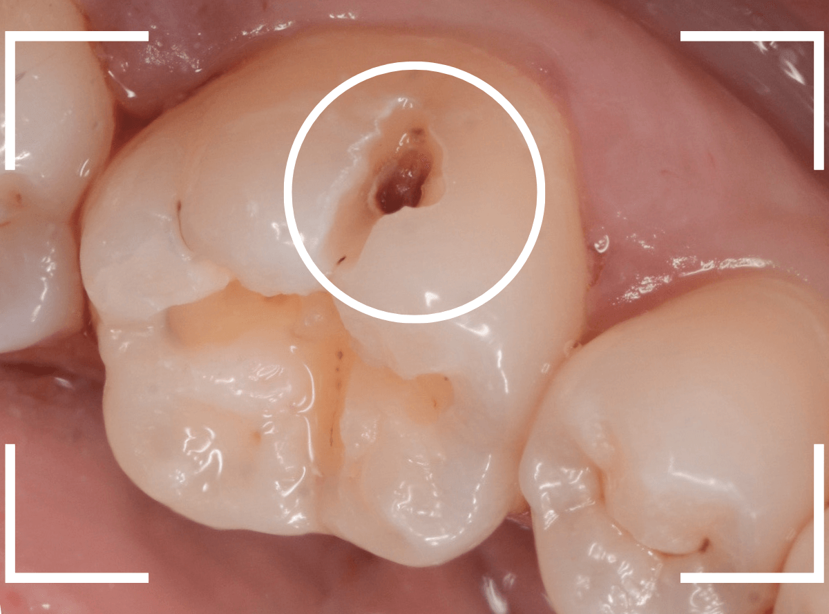 レントゲンでわかりづらい虫歯4-3