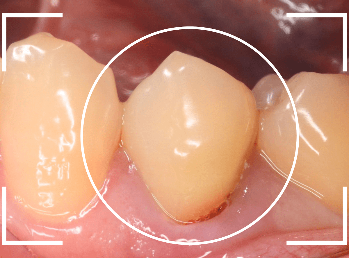 歯頚部う蝕の治療