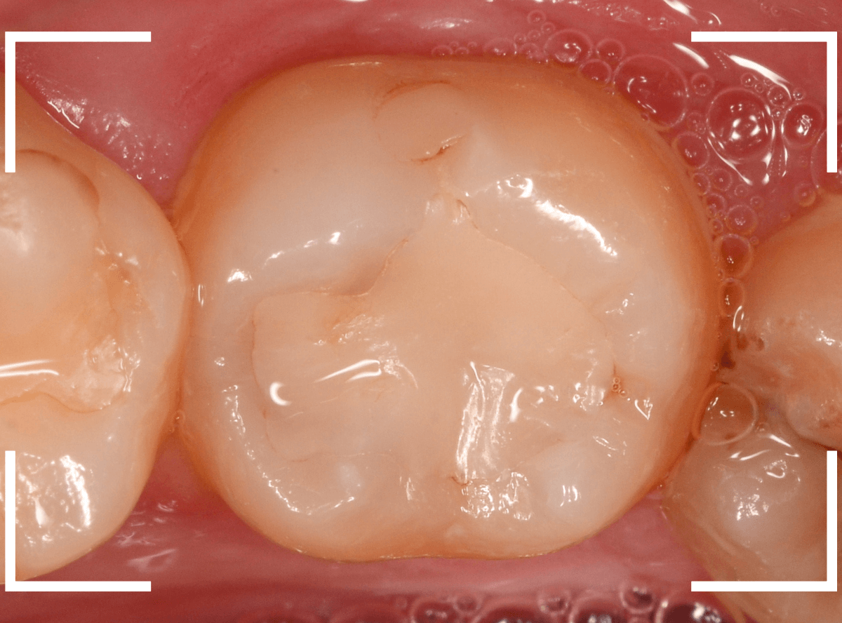 レントゲンでわかりづらい虫歯17-1