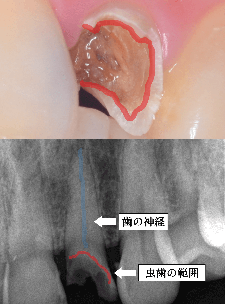 「前歯が折れた」という患者さん-1